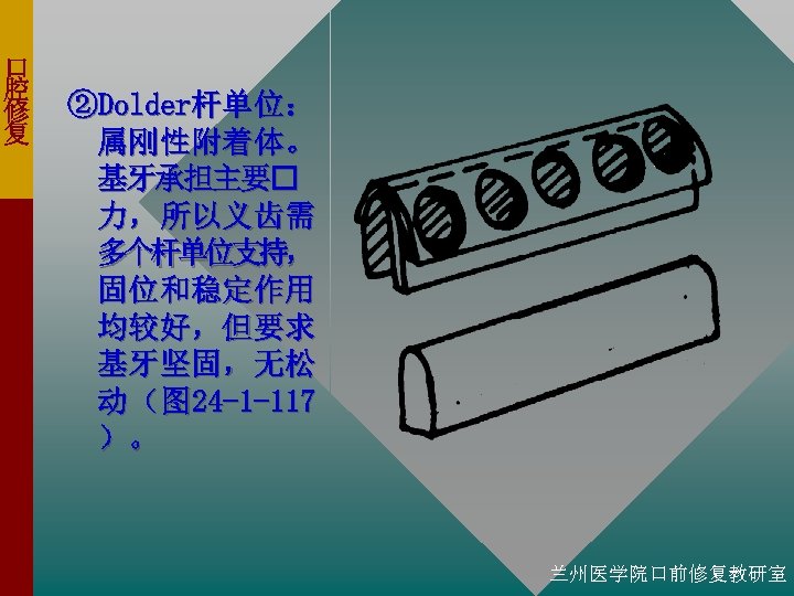 口 腔 修 复 ②Dolder杆单位： 属刚性附着体。 基牙承担主要 力，所以义齿需 多个杆单位支持， 固位和稳定作用 均较好，但要求 基牙坚固，无松 动 （
