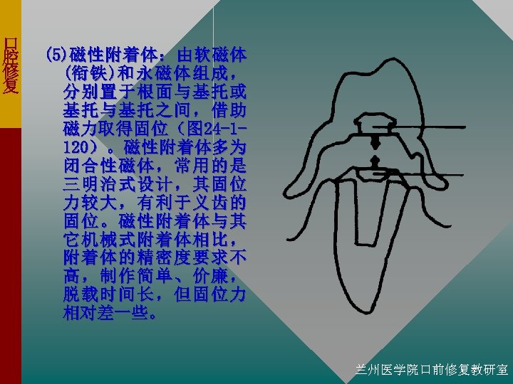 口 腔 修 复 (5)磁 性 附 着 体 ： 由 软 磁 体