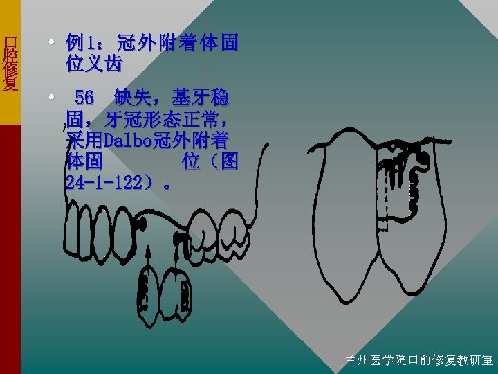 口 腔 修 复 • 例 1： 冠 外 附 着 体 固 位义齿