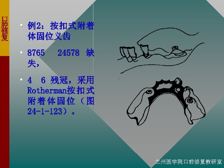 口 腔 修 复 • 例 2： 按 扣 式 附 着 体固位义齿 •