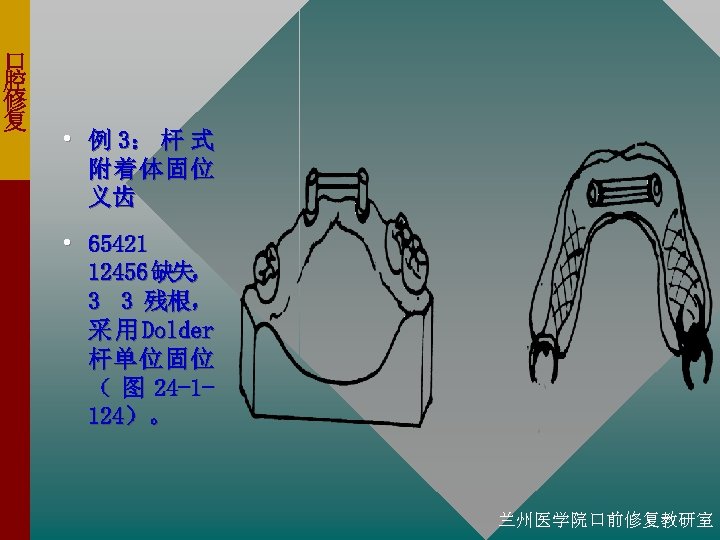 口 腔 修 复 • 例 3： 杆 式 附着体固位 义齿 • 65421 12456