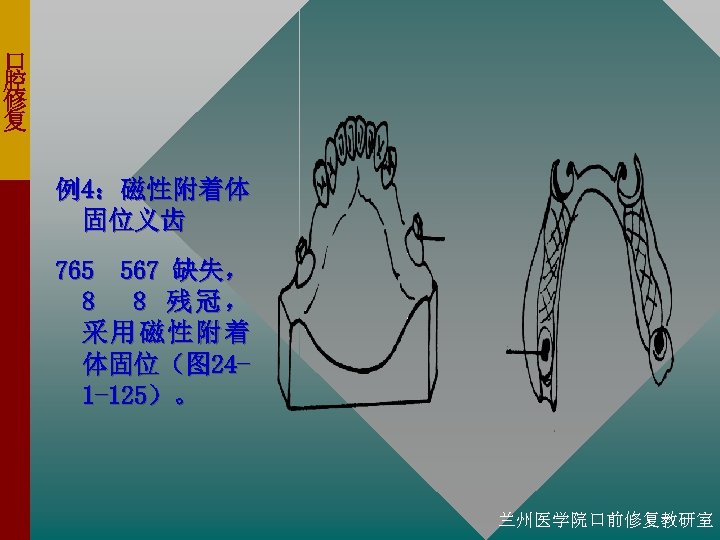 口 腔 修 复 例4：磁性附着体 固位义齿 765 567 缺失， 8 8 残冠， 采用磁性附着 体固位（图
