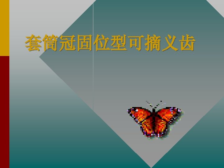 套筒冠固位型可摘义齿 