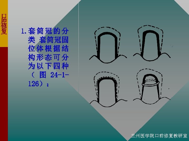 口 腔 修 复 1. 套 筒 冠 的 分 类 套筒冠固 位体根据结 构形态可分
