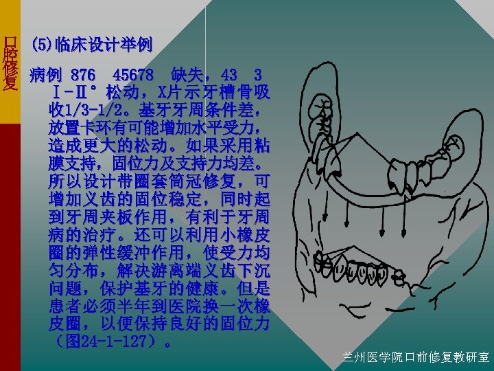 口 (5)临床设计举例 腔 修 病例 876 45678 缺失，43 3 复 Ⅰ-Ⅱ°松 动 ， X片