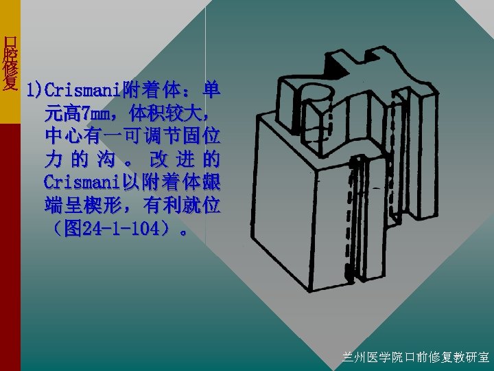 口 腔 修 复 1)Crismani附 着 体 ： 单 元高 7 mm，体积较大， 中心有一可调节固位 力的沟。改进的