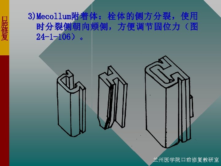 口 腔 修 复 3)Mecollum附 着 体 ： 栓 体 的 侧 方 分