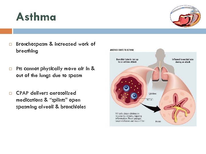 Asthma Bronchospasm & increased work of breathing Pts cannot physically move air in &