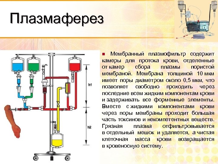 Плазмаферез Мембранный плазмофильтр содержит камеры для протока крови, отделенные от камер сбора плазмы пористой