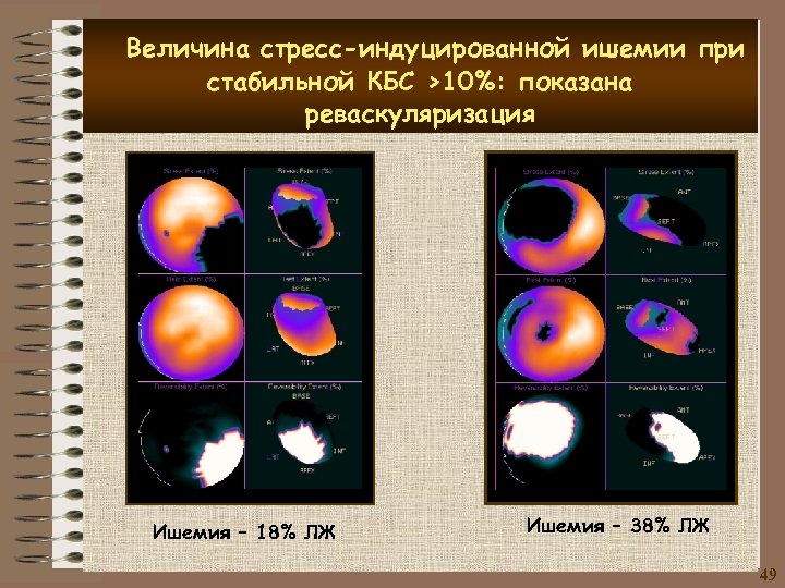 Величина стресс-индуцированной ишемии при стабильной КБС >10%: показана реваскуляризация Ишемия – 18% ЛЖ Ишемия