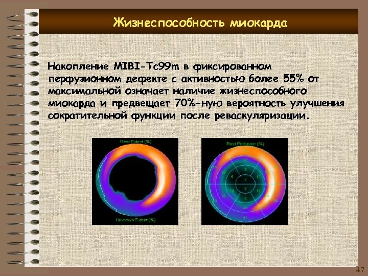 Жизнеспособность миокарда Накопление MIBI-Tc 99 m в фиксированном перфузионном дефекте с активностью более 55%