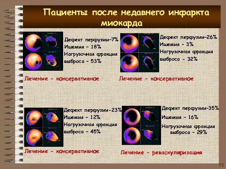 Пациенты после недавнего инфаркта миокарда • • Дефект перфузии– 26% Ишемия – 3% Нагрузочная