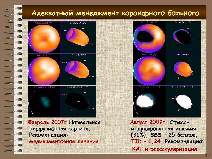 Адекватный менеджмент коронарного больного Февраль 2007 г. Нормальная перфузионная картина. Рекомендация: медикаментозное лечение. Август