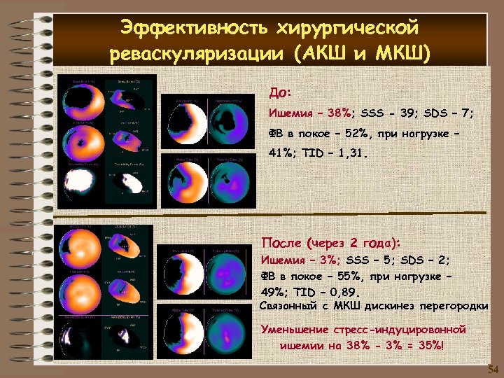 Эффективность хирургической реваскуляризации (АКШ и МКШ) До: Ишемия – 38%; SSS - 39; SDS