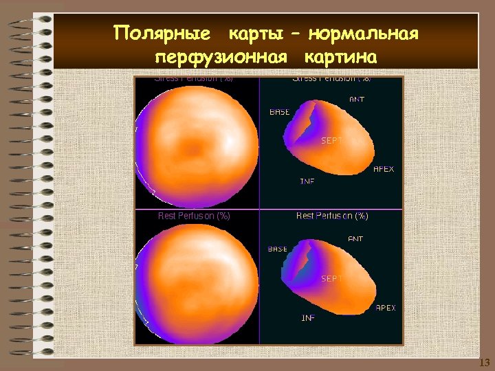 Полярные карты – нормальная перфузионная картина 13 