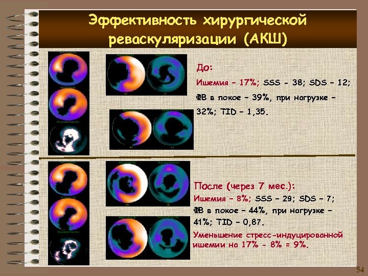 Эффективность хирургической реваскуляризации (АКШ) До: Ишемия – 17%; SSS - 38; SDS – 12;