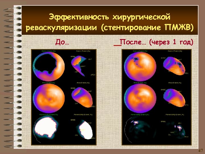 Эффективность хирургической реваскуляризации (стентирование ПМЖВ) До… После… (через 1 год) 47 