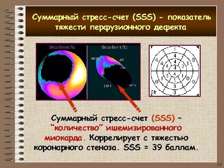 Суммарный стресс-счет (SSS) - показатель тяжести перфузионного дефекта ё Суммарный стресс-счет (SSS) – “количество”