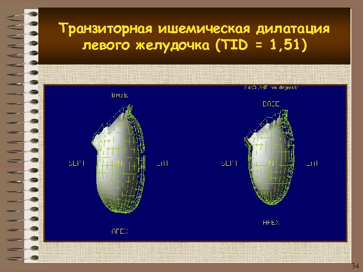 Транзиторная ишемическая дилатация левого желудочка (TID = 1, 51) 34 