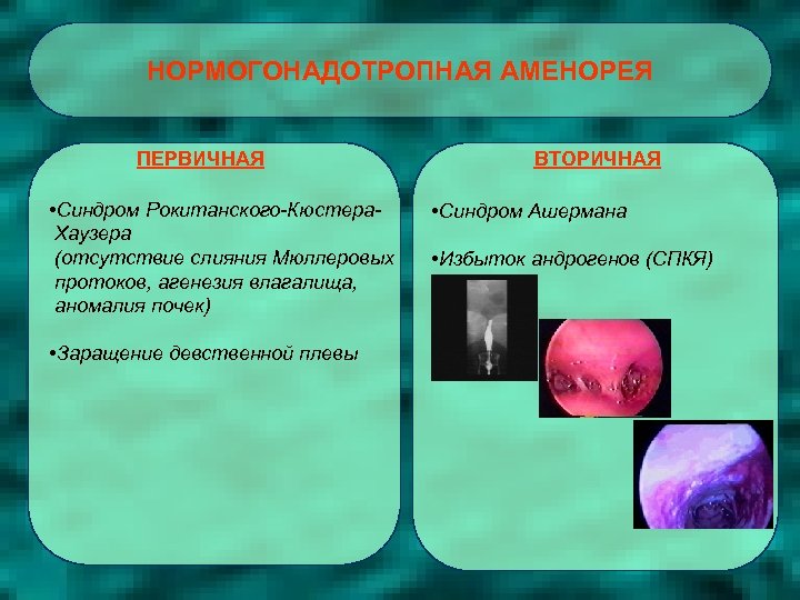 НОРМОГОНАДОТРОПНАЯ АМЕНОРЕЯ ПЕРВИЧНАЯ • Синдром Рокитанского-Кюстера. Хаузера (отсутствие слияния Мюллеровых протоков, агенезия влагалища, аномалия