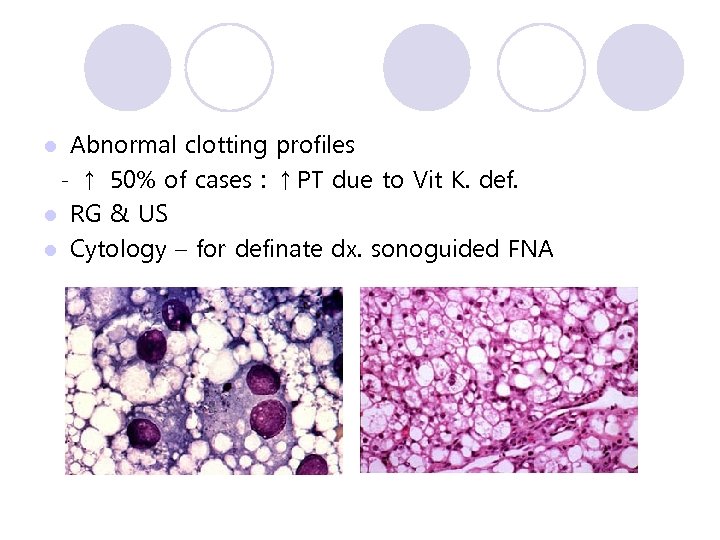 Abnormal clotting profiles - ↑ 50% of cases : ↑PT due to Vit K.