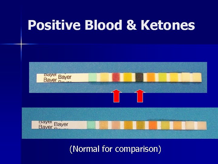 Positive Blood & Ketones (Normal for comparison) 