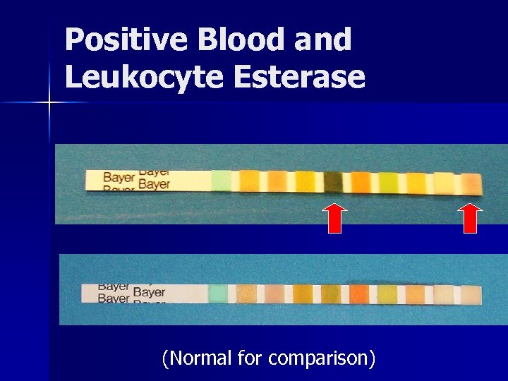 Positive Blood and Leukocyte Esterase (Normal for comparison) 