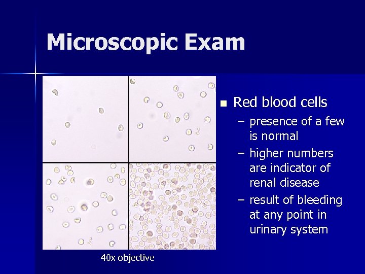 Microscopic Exam n Red blood cells – presence of a few is normal –