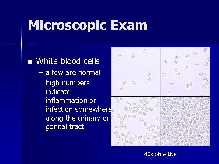 Microscopic Exam n White blood cells – a few are normal – high numbers