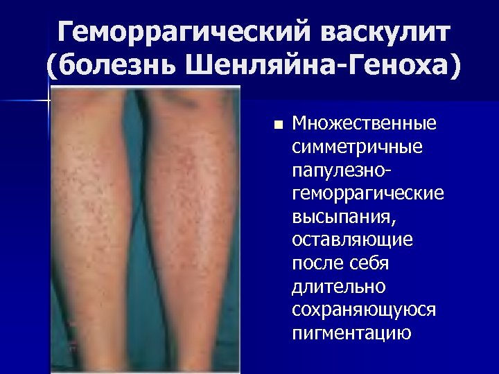 Геморрагический васкулит (болезнь Шенляйна-Геноха) n Множественные симметричные папулезногеморрагические высыпания, оставляющие после себя длительно сохраняющуюся