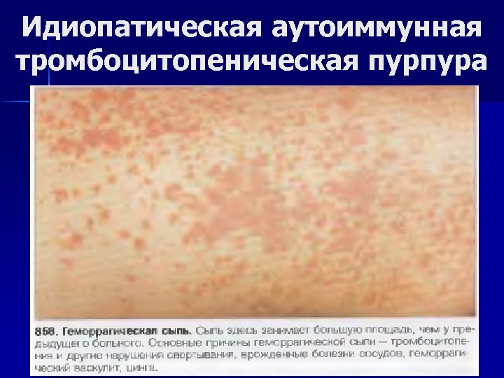 Идиопатическая аутоиммунная тромбоцитопеническая пурпура 