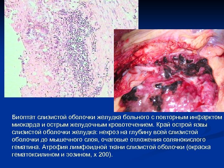 Биоптат слизистой оболочки желудка больного с повторным инфарктом миокарда и острым желудочным кровотечением. Край
