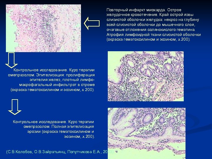 Повторный инфаркт миокарда. Острое желудочное кровотечение. Край острой язвы слизистой оболочки желудка: некроз на