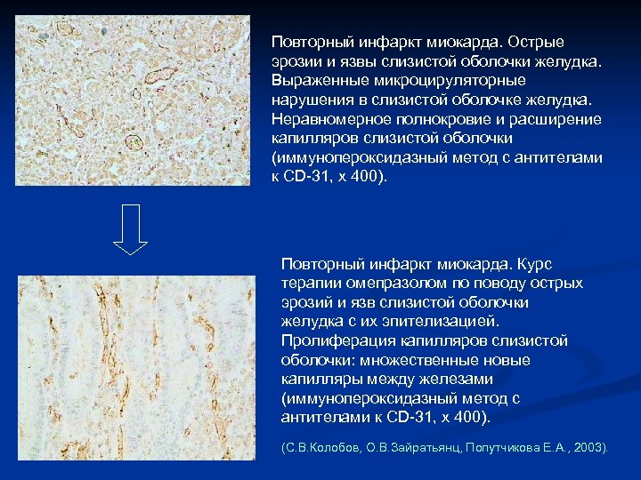 Повторный инфаркт миокарда. Острые эрозии и язвы слизистой оболочки желудка. Выраженные микроцируляторные нарушения в