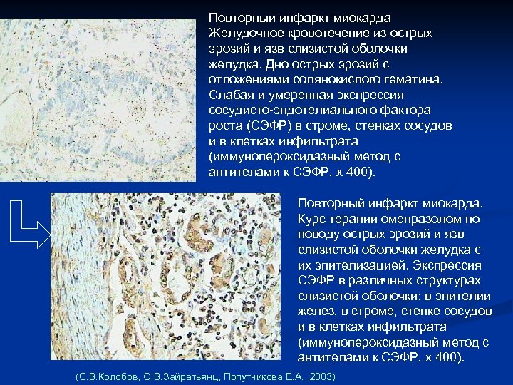 Повторный инфаркт миокарда Желудочное кровотечение из острых эрозий и язв слизистой оболочки желудка. Дно