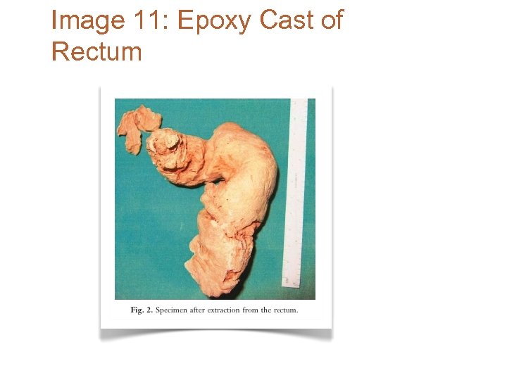 Image 11: Epoxy Cast of Rectum 