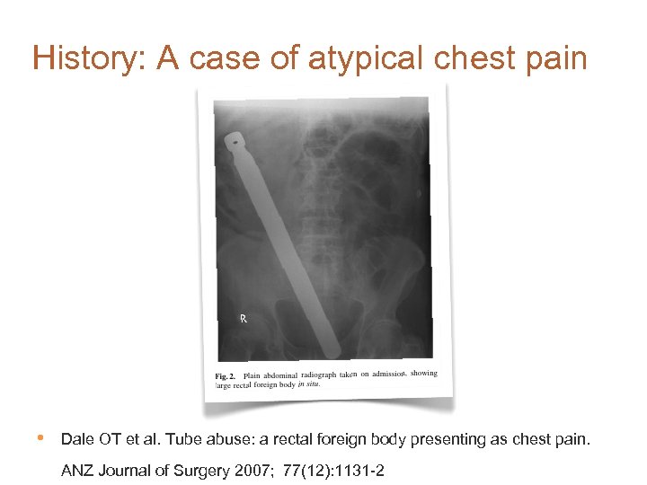 History: A case of atypical chest pain • Dale OT et al. Tube abuse: