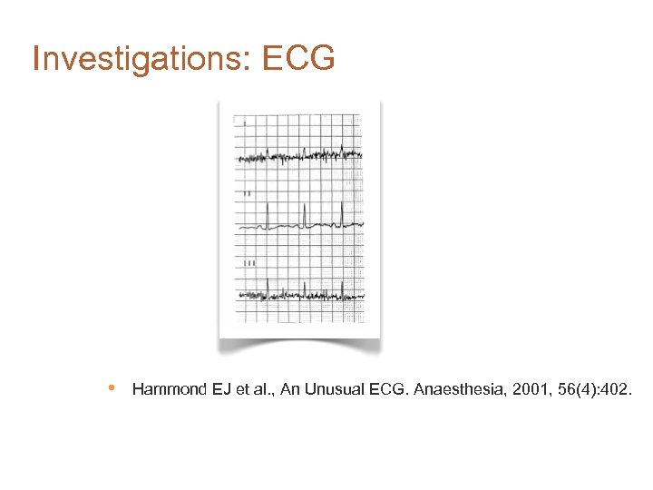 Investigations: ECG • Hammond EJ et al. , An Unusual ECG. Anaesthesia, 2001, 56(4):