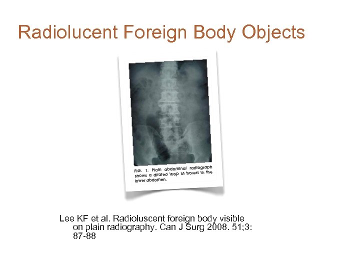 Radiolucent Foreign Body Objects Lee KF et al. Radioluscent foreign body visible on plain