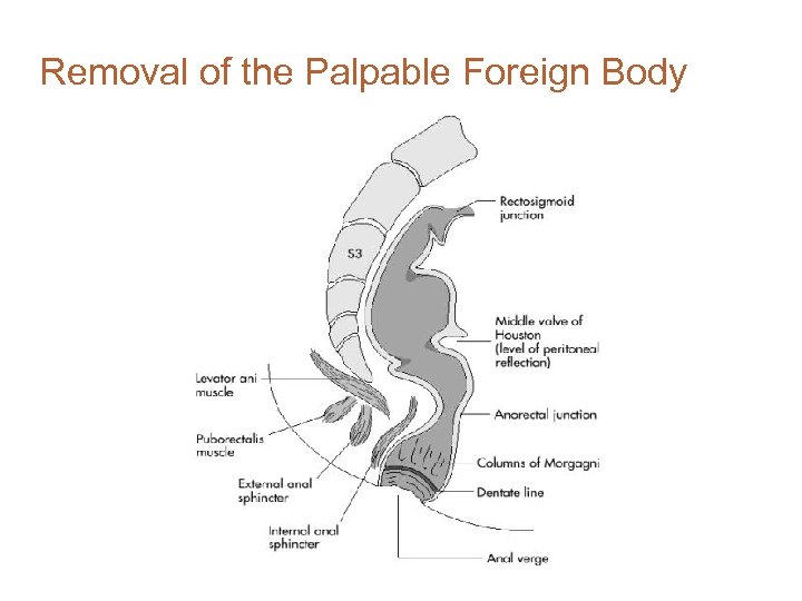 Removal of the Palpable Foreign Body 