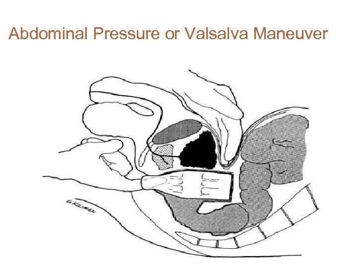 Abdominal Pressure or Valsalva Maneuver 