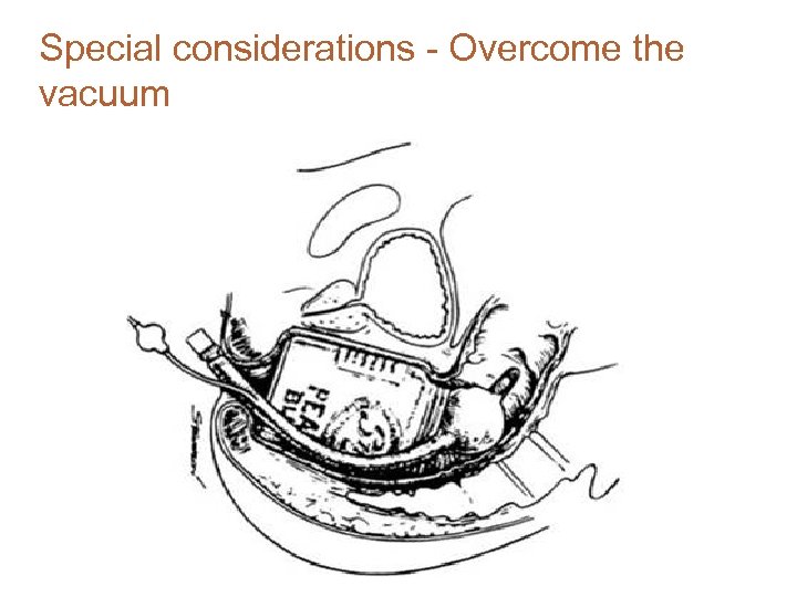 Special considerations - Overcome the vacuum 