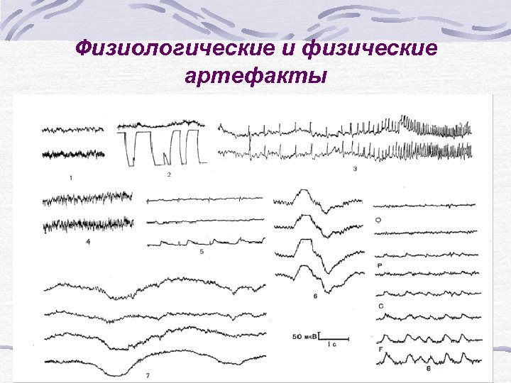 Физиологические и физические артефакты 