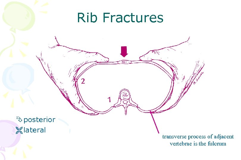 Rib Fractures Ê posterior Ë lateral transverse process of adjacent vertebrae is the fulcrum