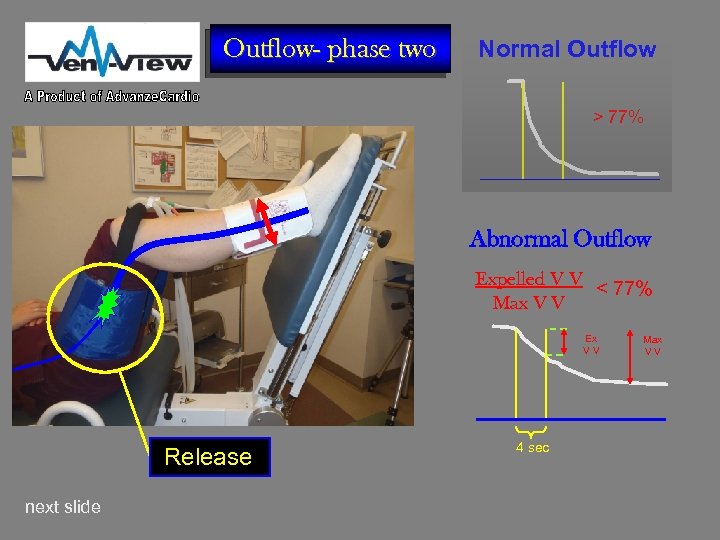 Outflow- phase two Normal Outflow > 77% Abnormal Outflow Expelled V V < 77%