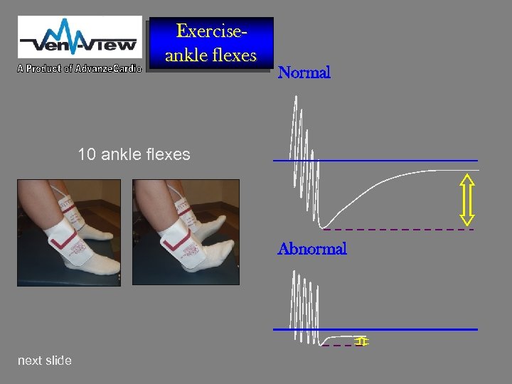 Exerciseankle flexes Normal 10 ankle flexes Abnormal next slide 