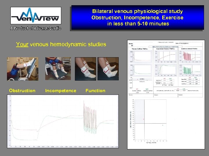 Bilateral venous physiological study Obstruction, Incompetence, Exercise in less than 5 -10 minutes Your