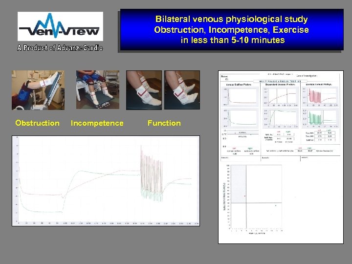 Bilateral venous physiological study Obstruction, Incompetence, Exercise in less than 5 -10 minutes Obstruction