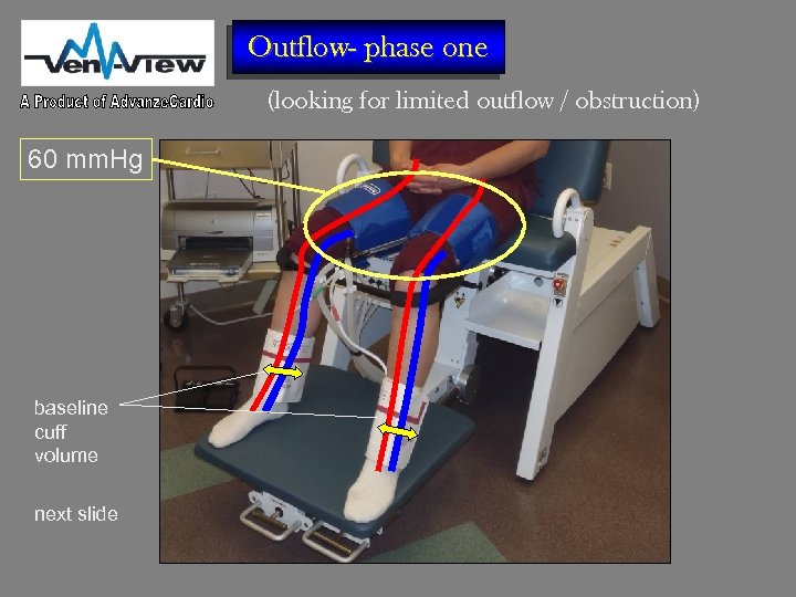 Outflow- phase one (looking for limited outflow / obstruction) 60 mm. Hg baseline cuff