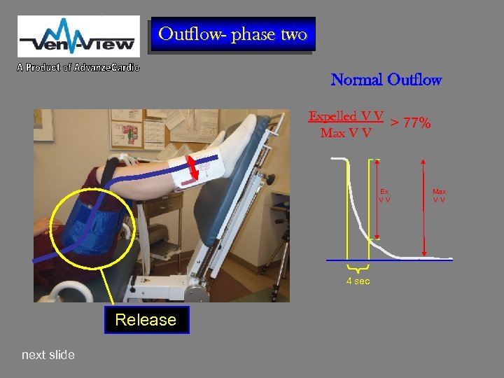 Outflow- phase two Normal Outflow Expelled V V > 77% Max V V Ex